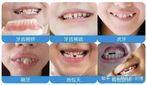 德国和美国的假牙区别在哪,德国全瓷牙和国产全瓷牙的区别(图1)